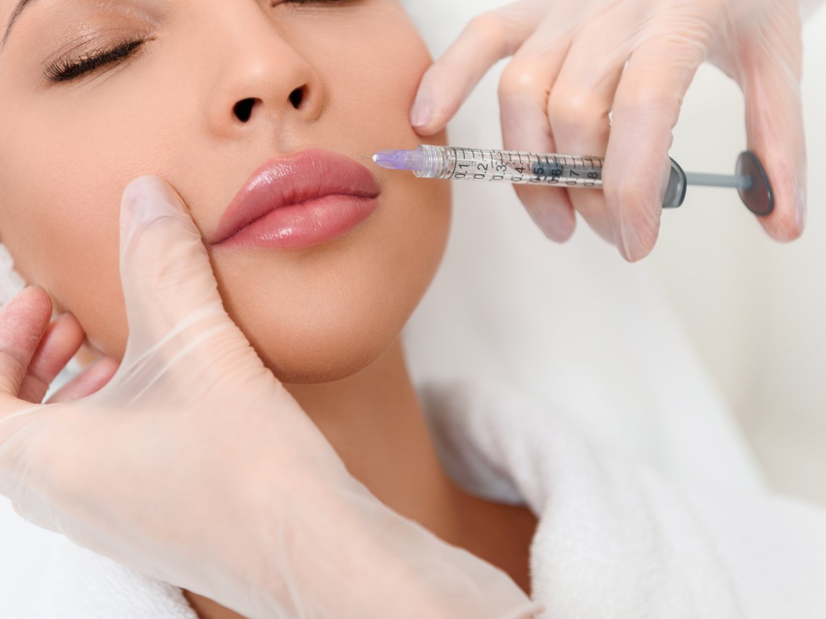 Hyaluronsäure Filler