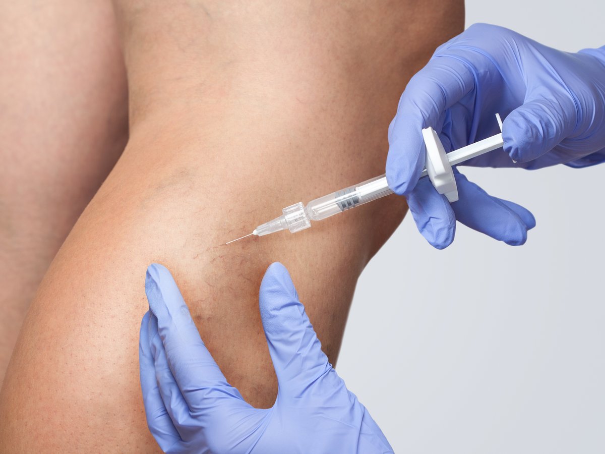 Phlebologie – Schaumsklerosierung
